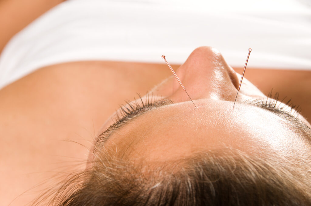 Akupunktur i ansigtet fjerner stress og kan give dig et yngre udseende